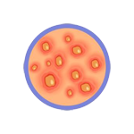 Bacterial Infections